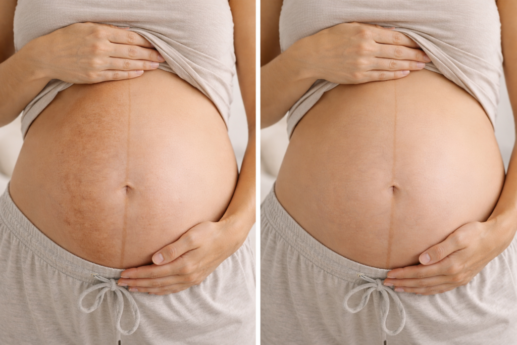Skin Darkening During Pregnancy Hyperpigmentation Remedies
